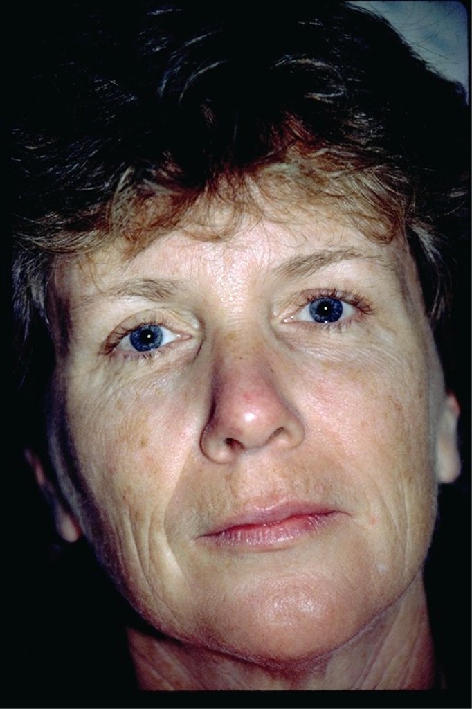 Before phenol peel