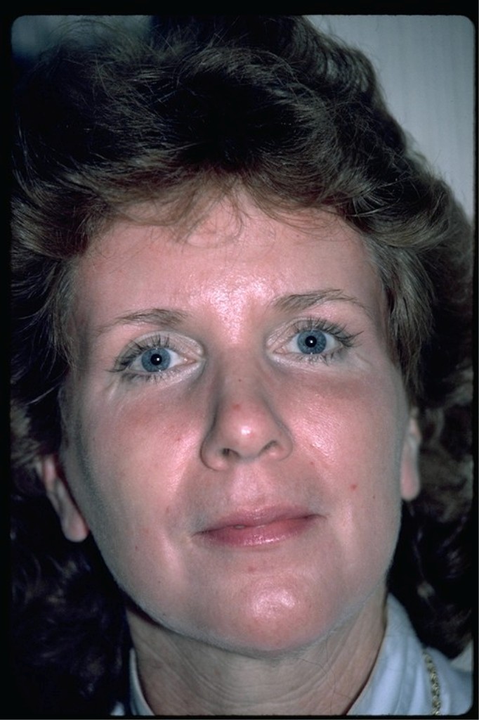 After phenol peel