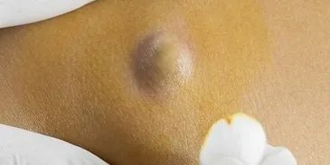 Lipomas
