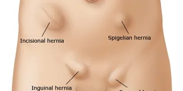 Hernias