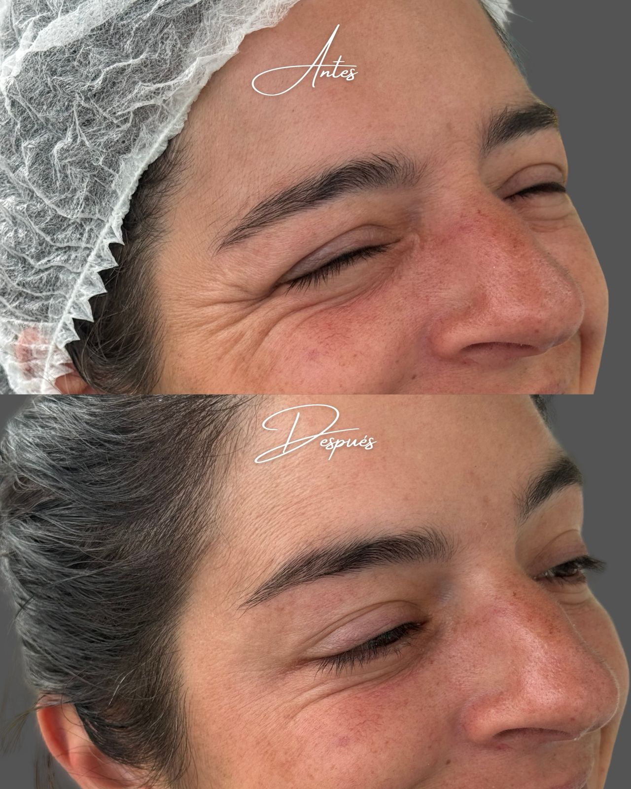 Resultado de tratamiento facial Dra. Katherine Agüero
