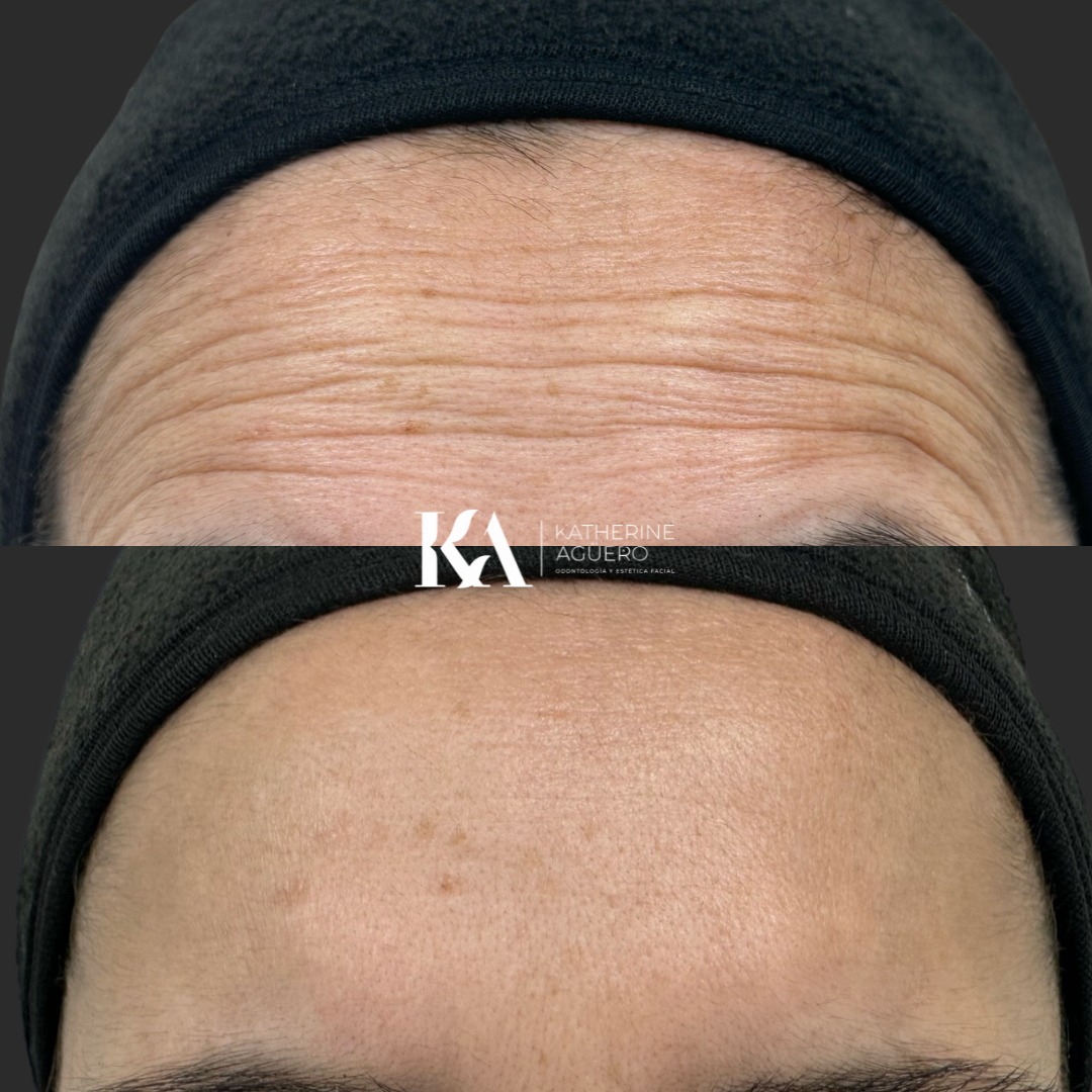 Resultado de tratamiento facial Dra. Katherine Agüero