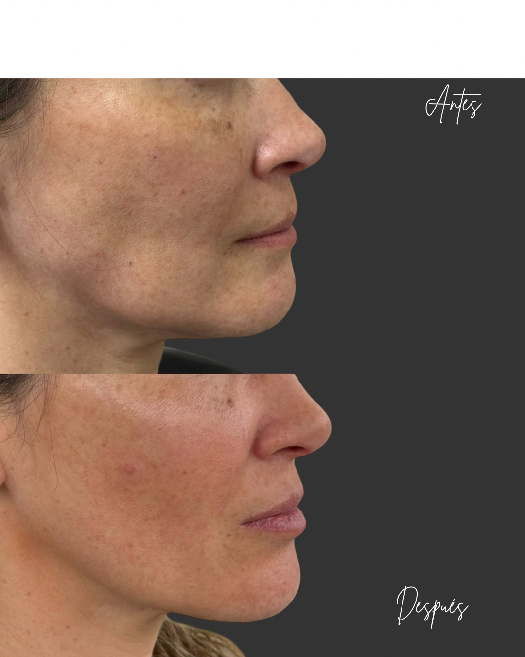 Resultado de tratamiento facial Dra. Katherine Agüero
