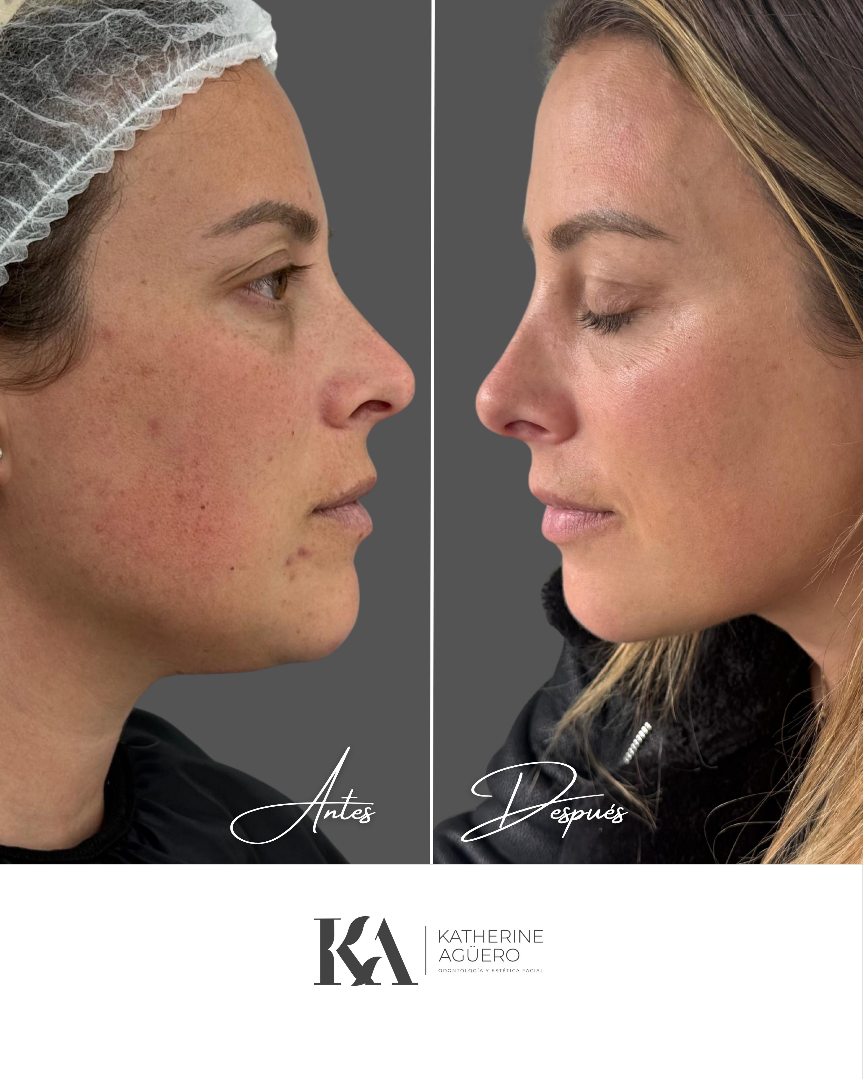 Resultado de tratamiento facial Dra. Katherine Agüero