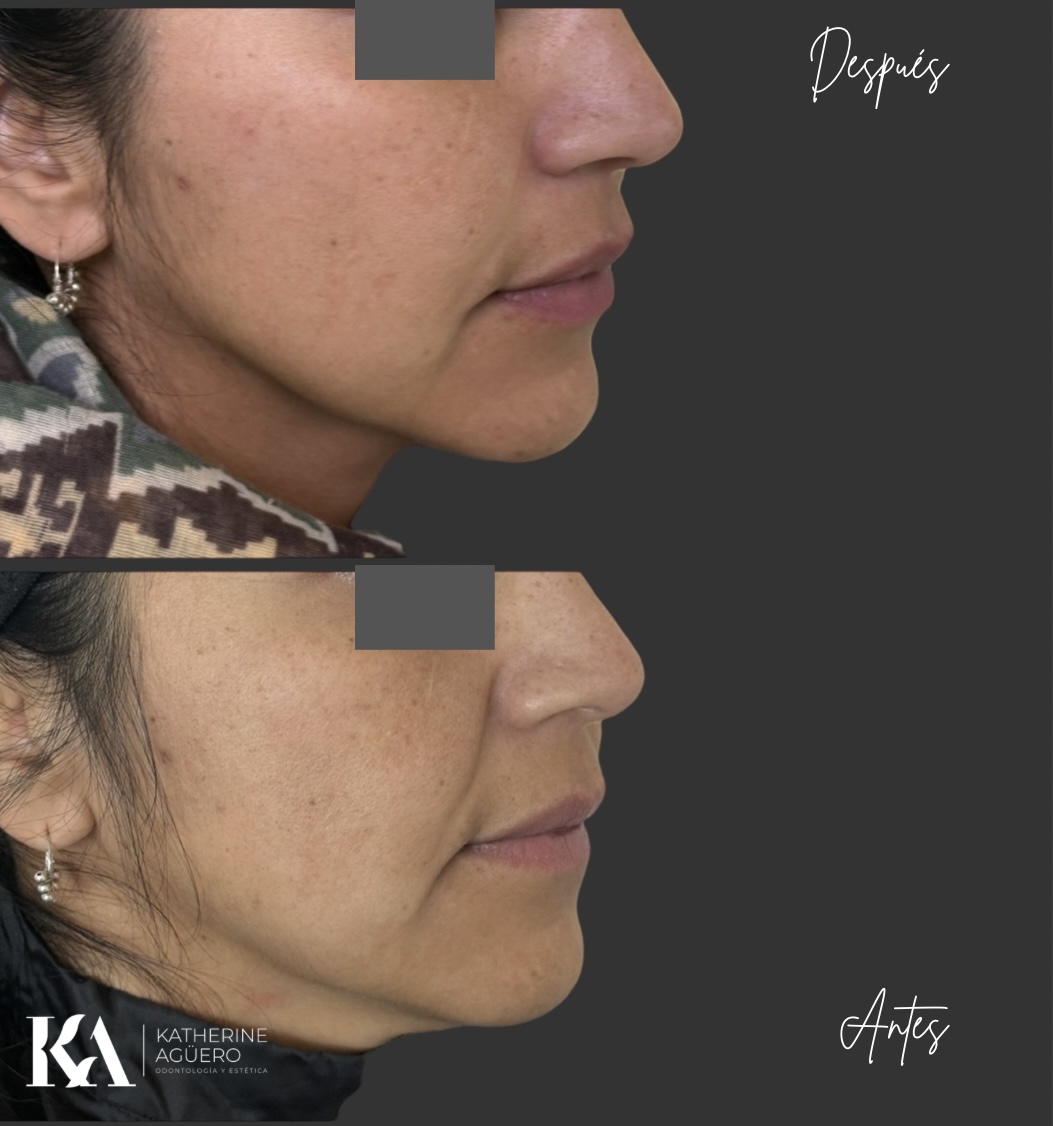 Resultado de tratamiento facial Dra. Katherine Agüero