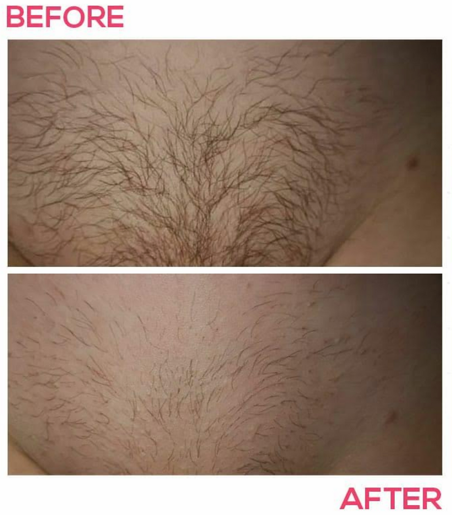 Before and after non-laser hair removal at Wild Orchid Spa