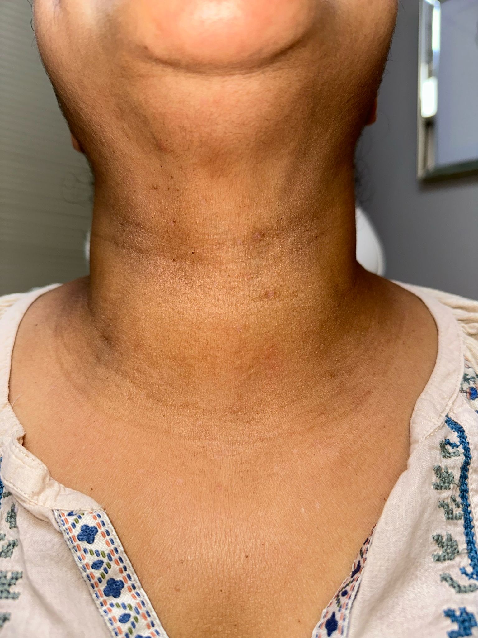 After skin tag removal on neck and chest, clear healed skin, Nature of Skin Dermatology Austin