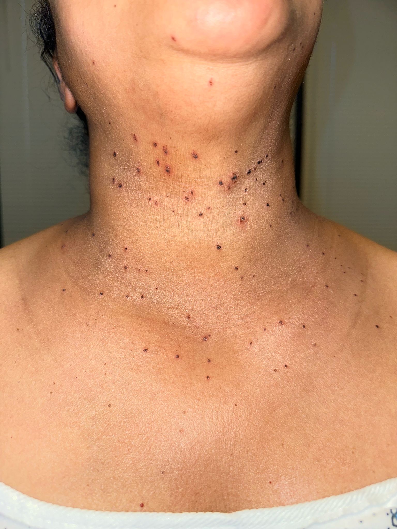 Before skin tag removal on neck and chest, multiple skin tags visible, Austin TX dermatologist
