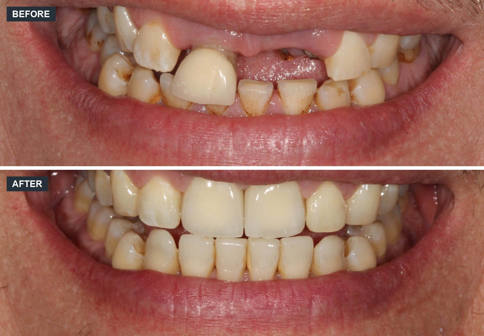 Dental implant before and after at Canon House Clinic
