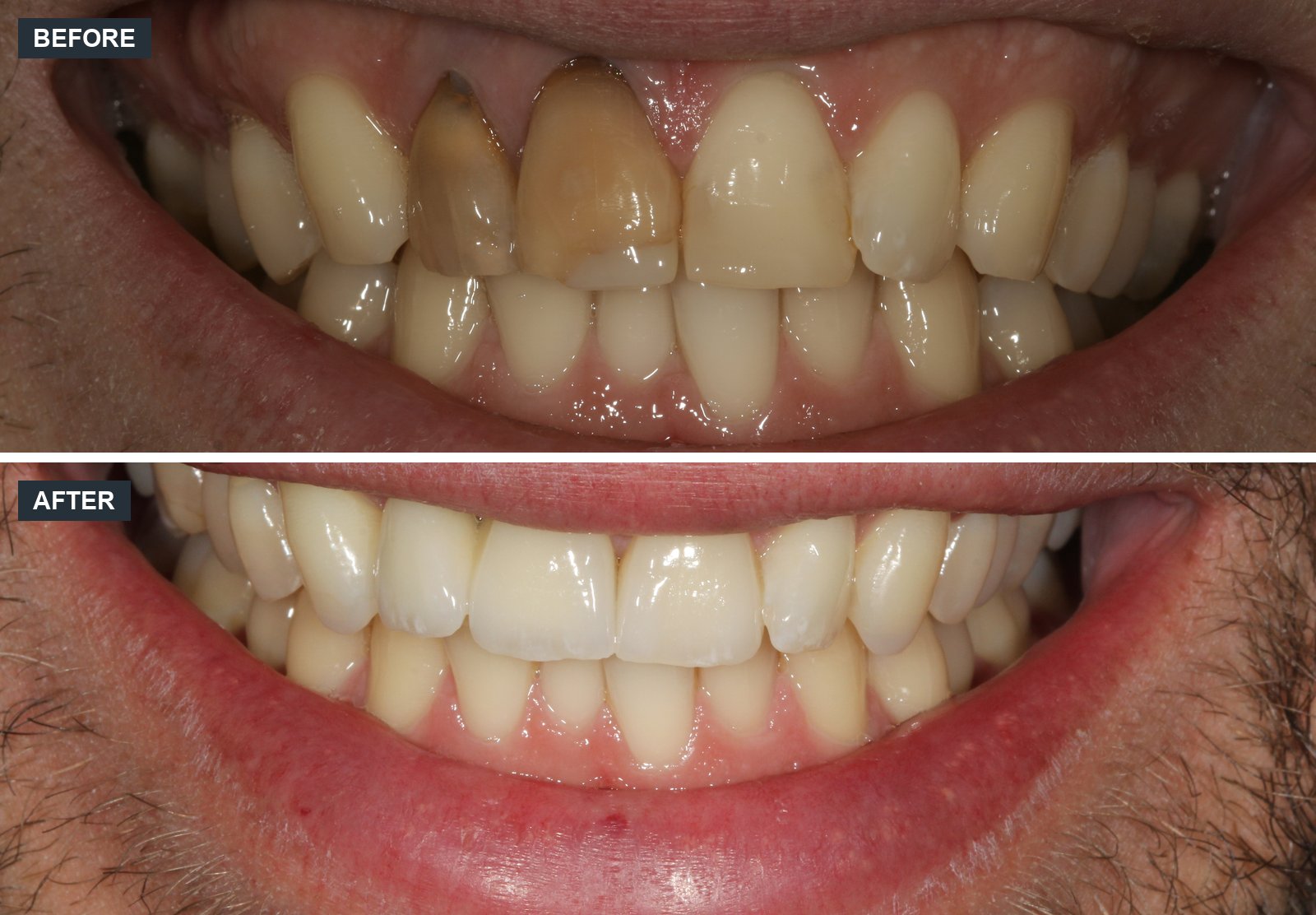 Failing front teeth before and after at Canon House Clinic