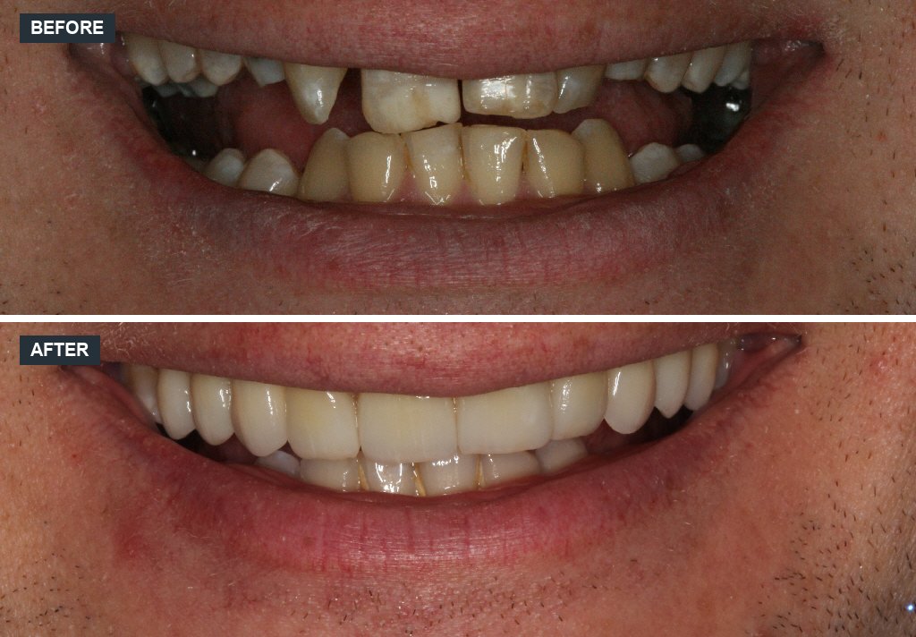 Full-arch restoration before and after at Canon House Clinic