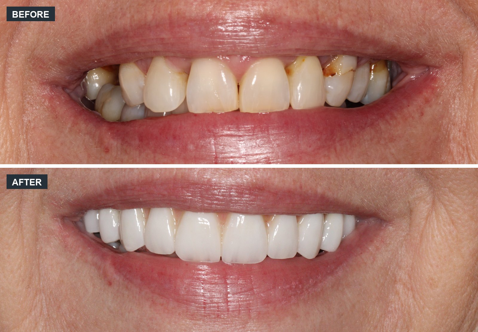 Smile restoration before and after at Canon House Clinic