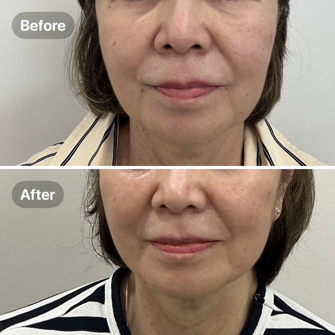 Before and after result