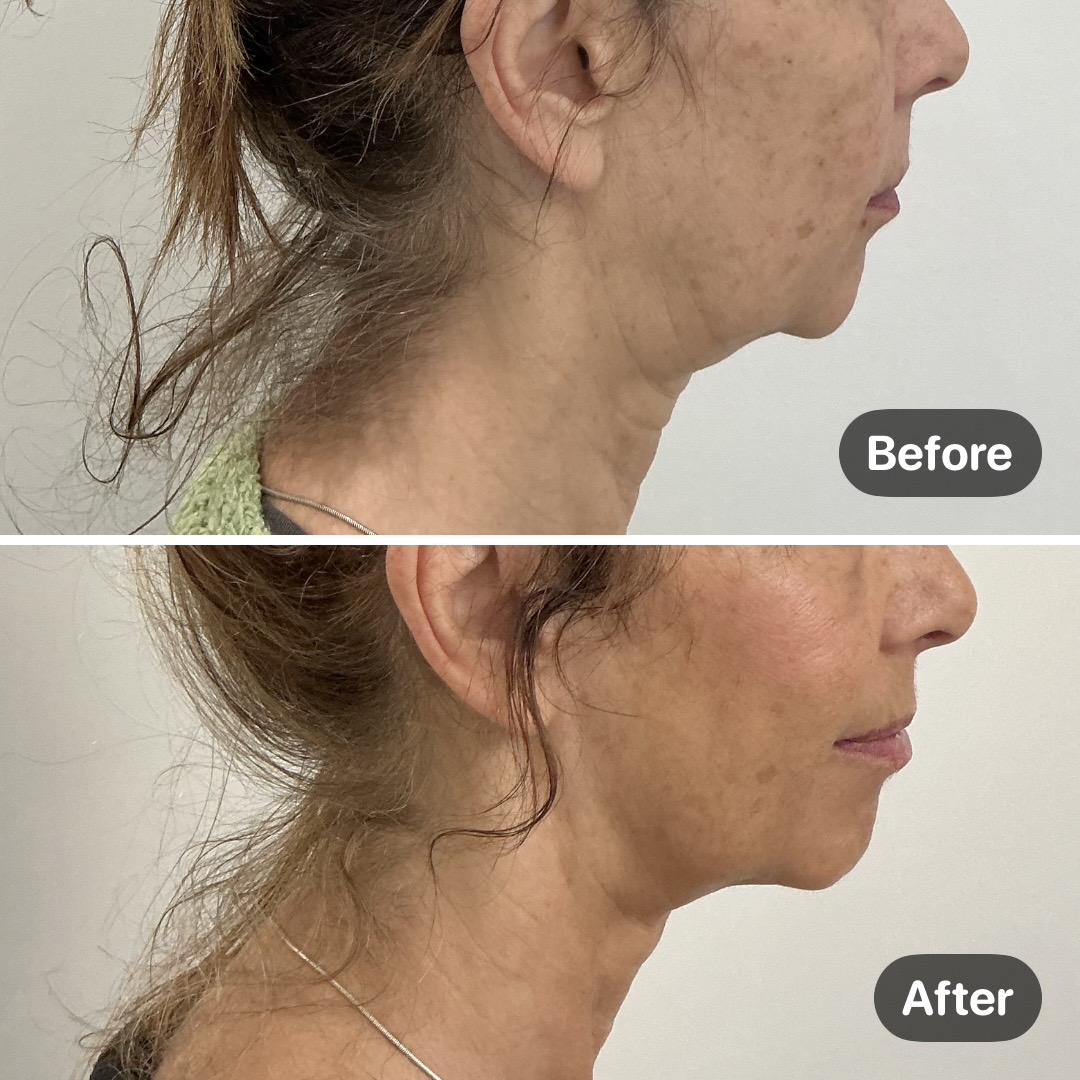 Before and after result