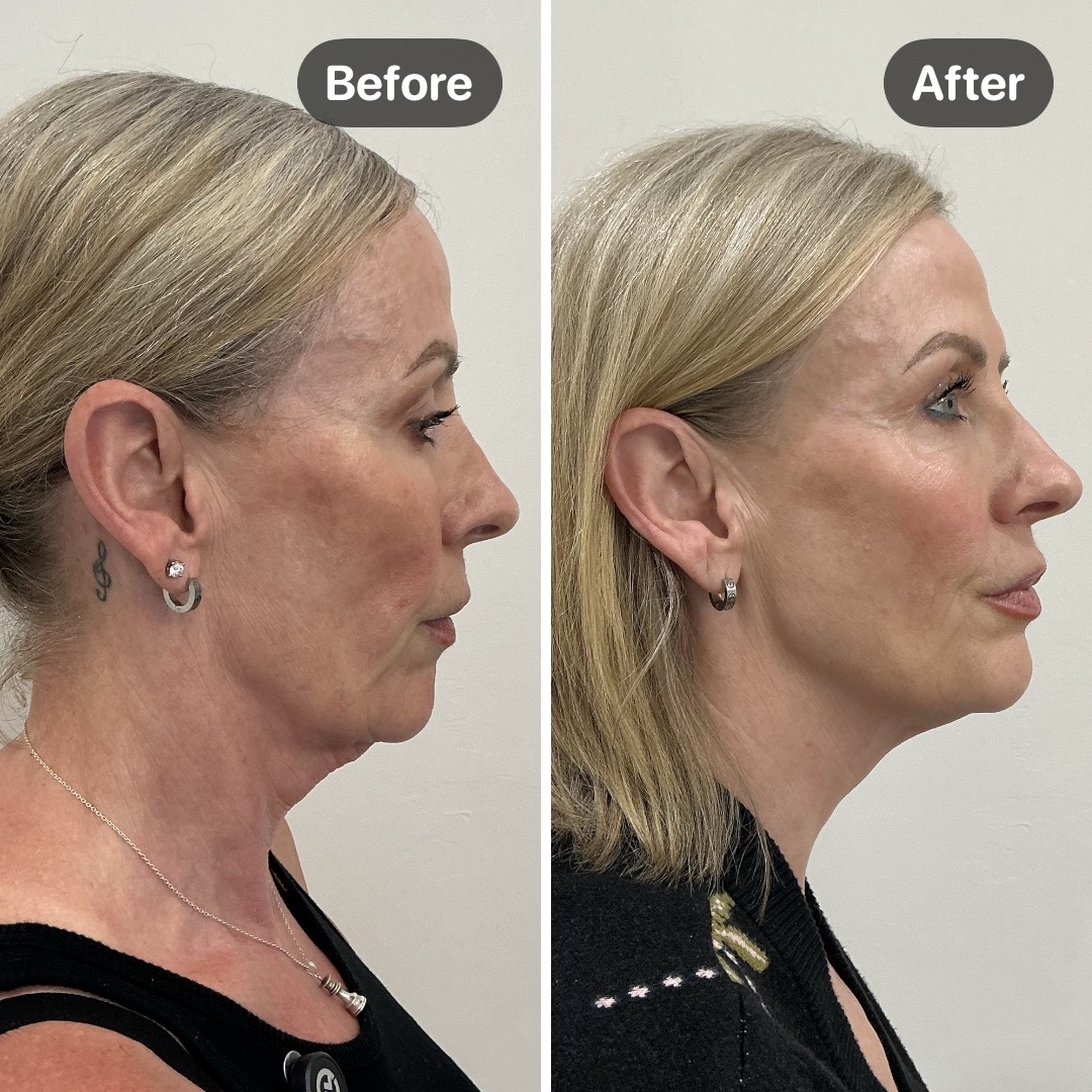 Before and after result