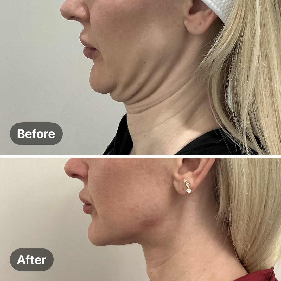 Before and after result