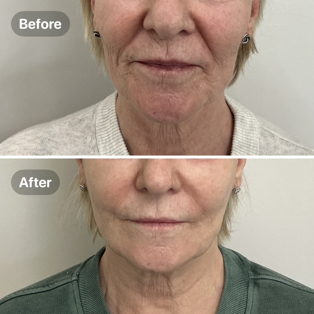 Before and after result