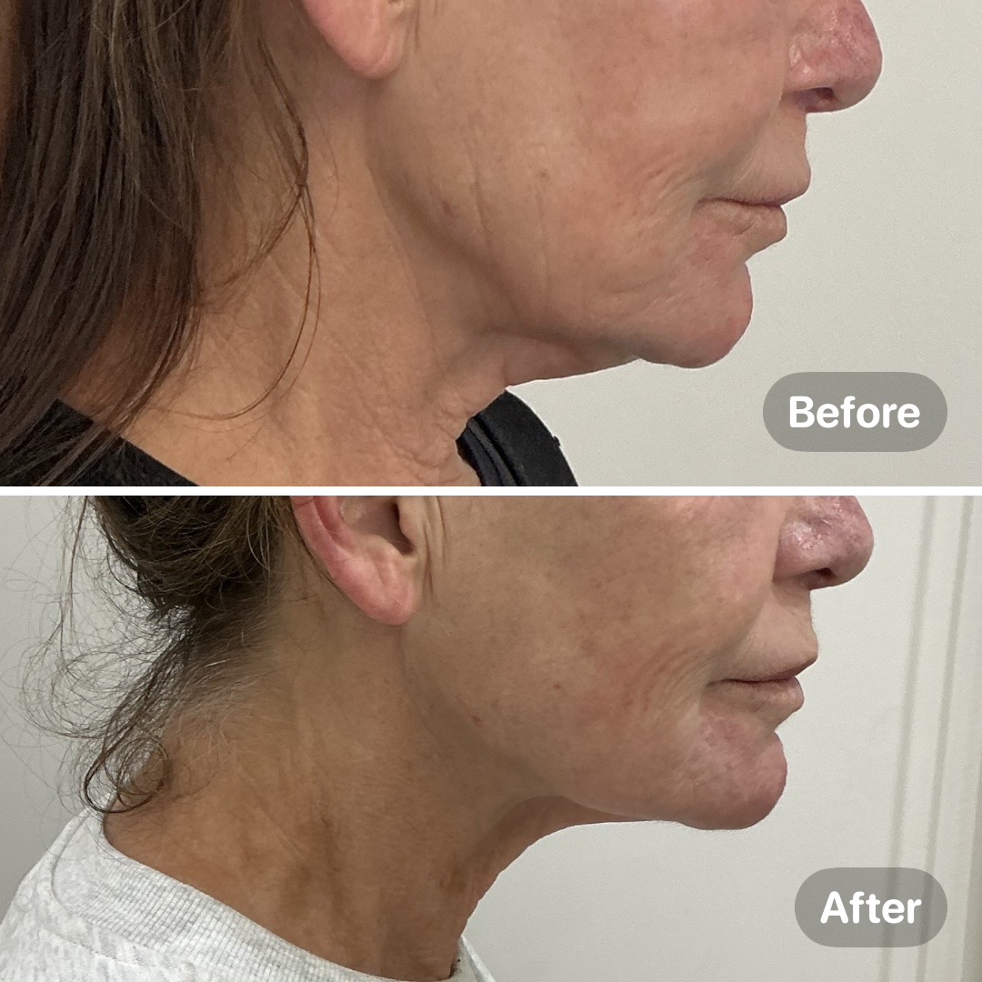 Before and after result