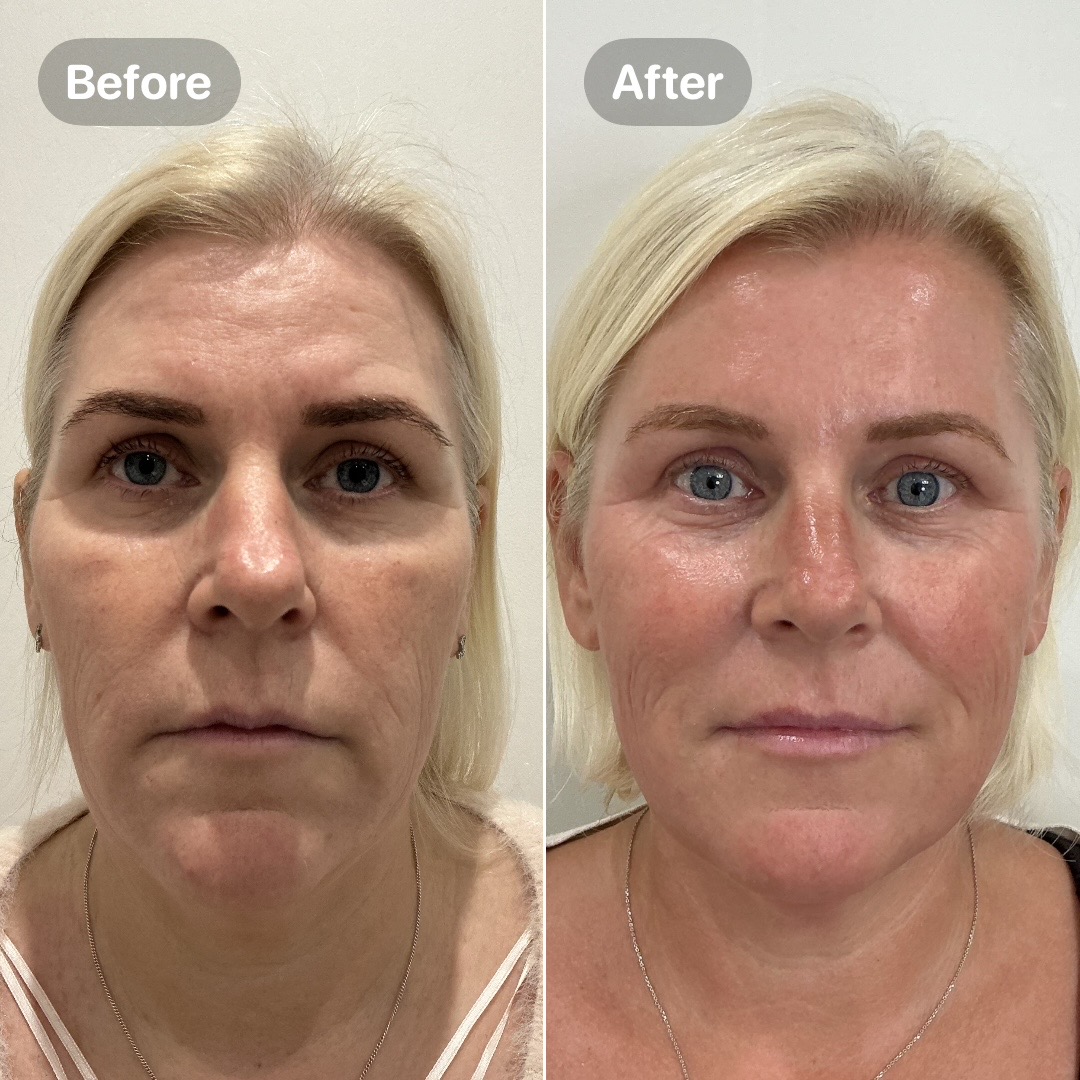 Before and after result
