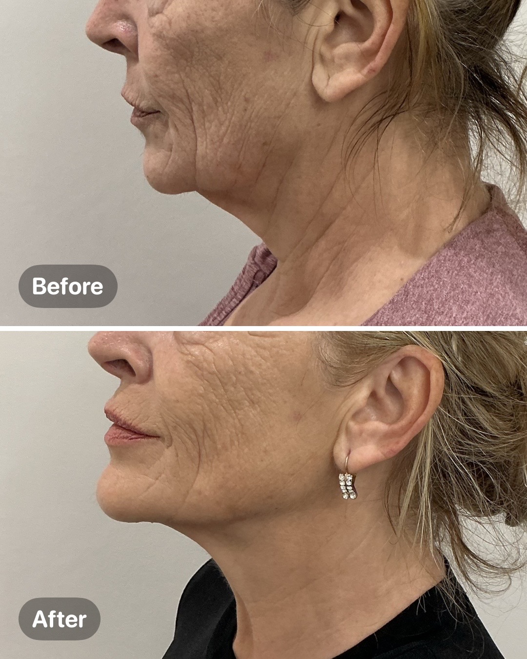 Before and after result