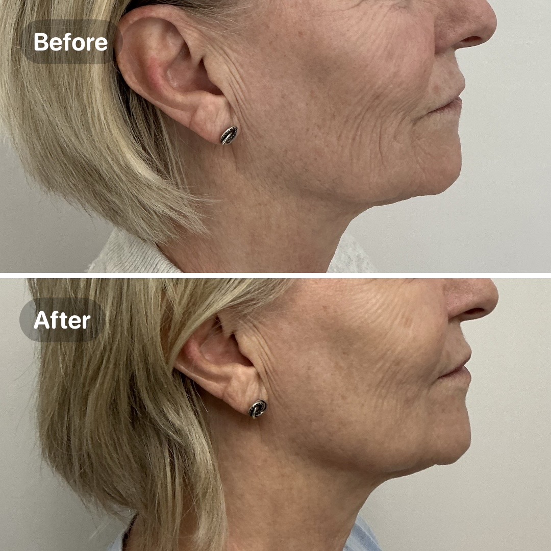 Before and after result