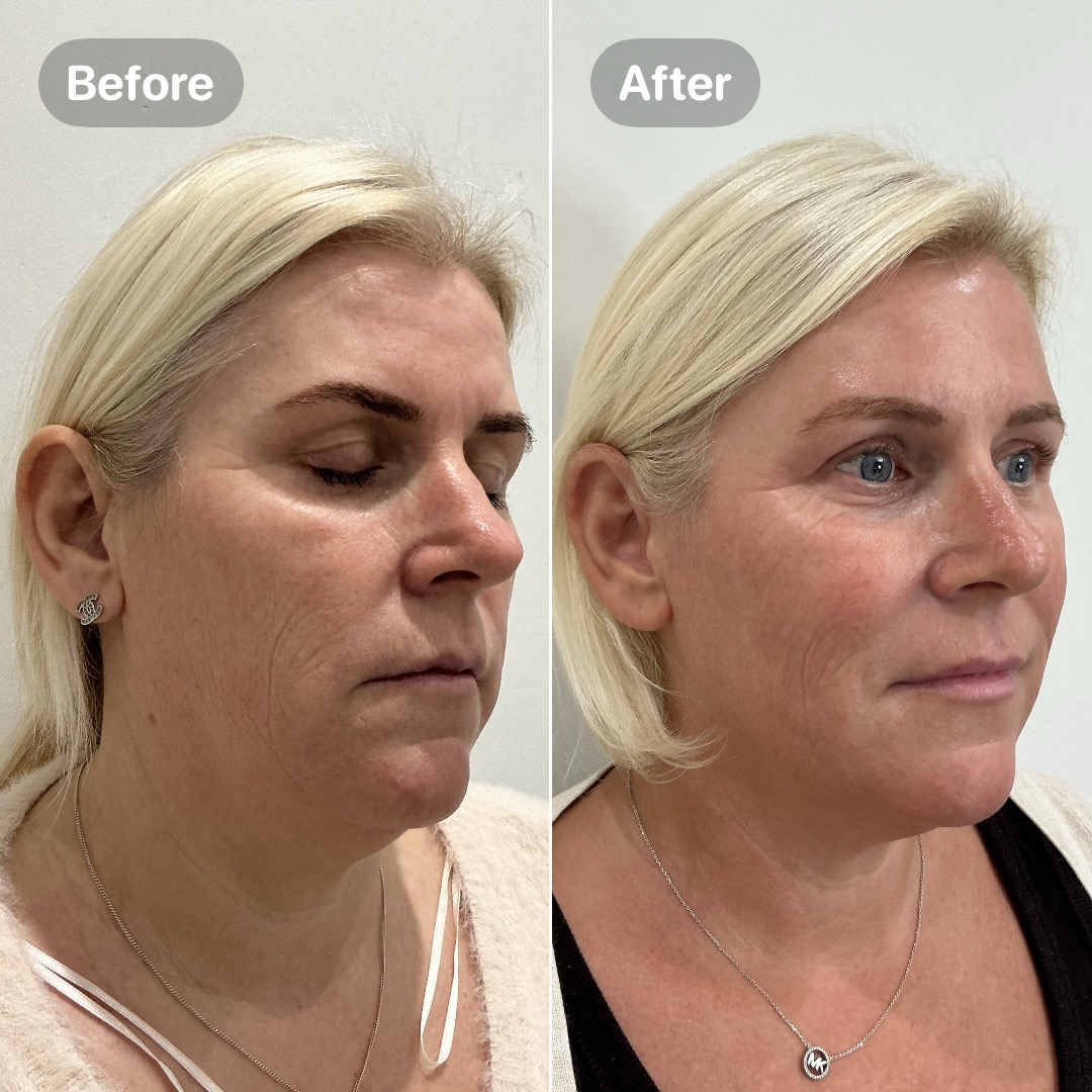 Before and after result