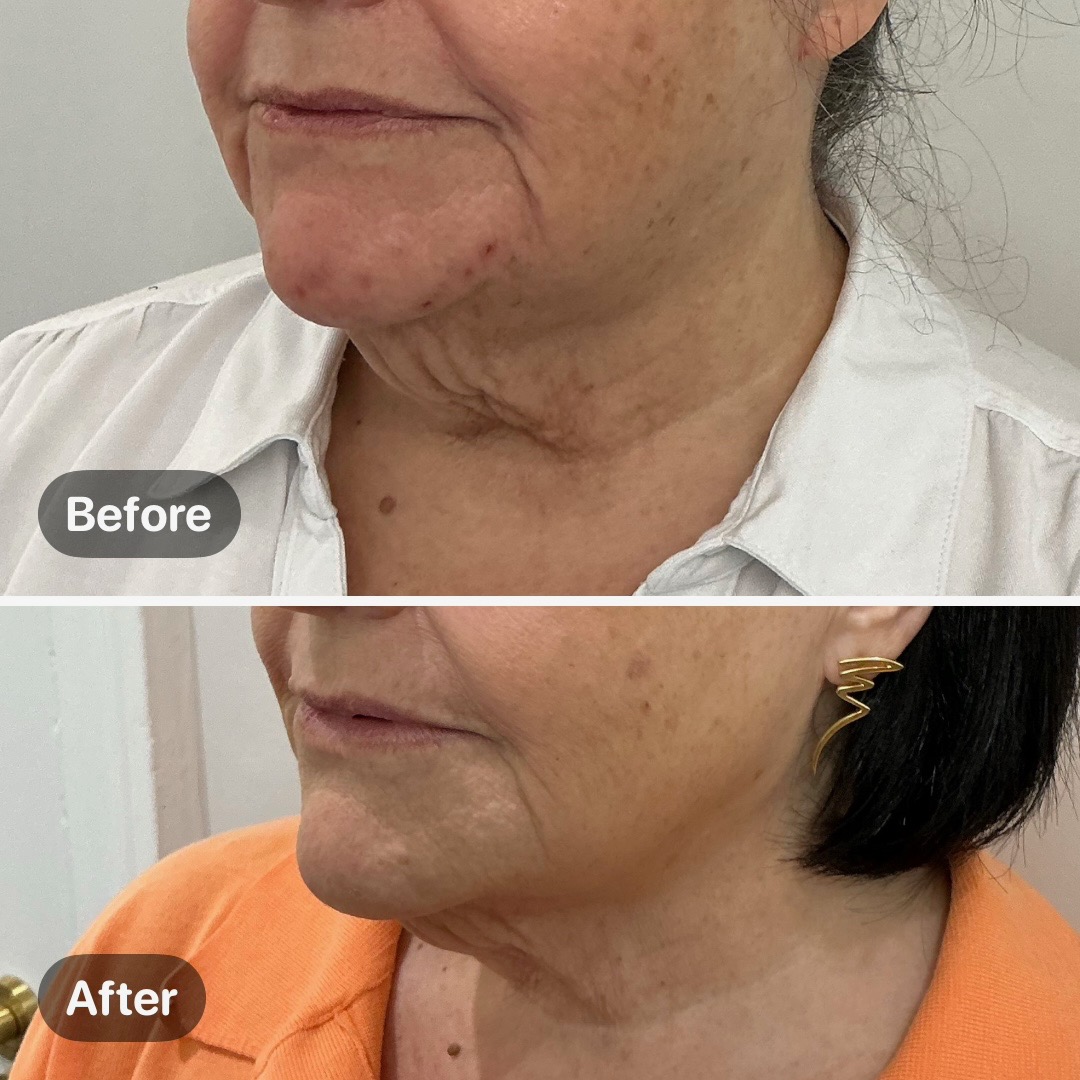 Before and after result