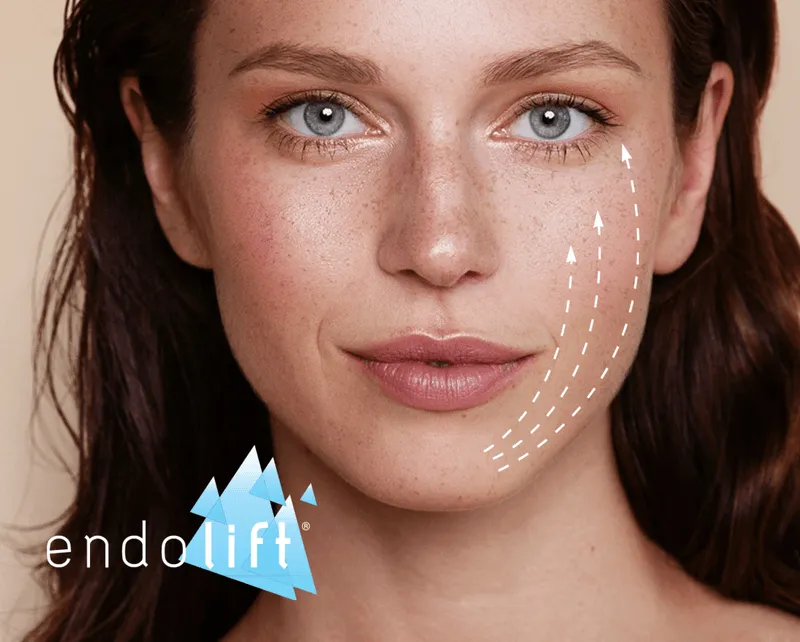 How the Endolift laser fibre works under the skin