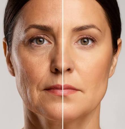 Endolift treatment results