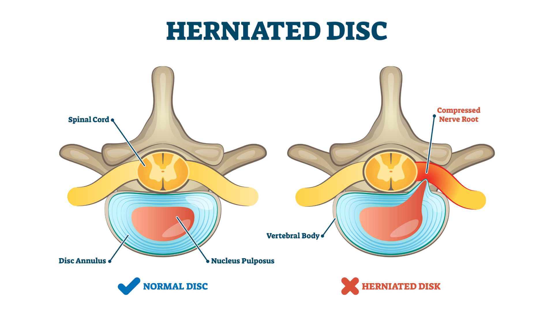 Gentle Solutions for Bulging Discs and Chronic Back Pain Gentle Solutions for Bulging Discs and Chronic Back Pain