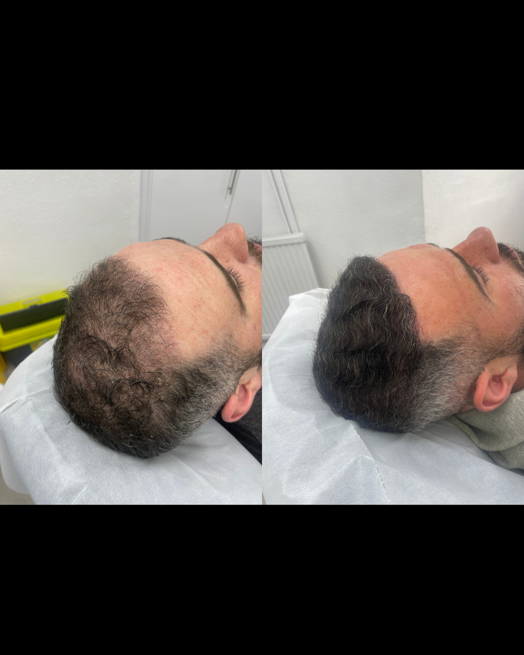 PRP Hair Restoration Before and After Result 1 – Oréa Aesthetics Clinic