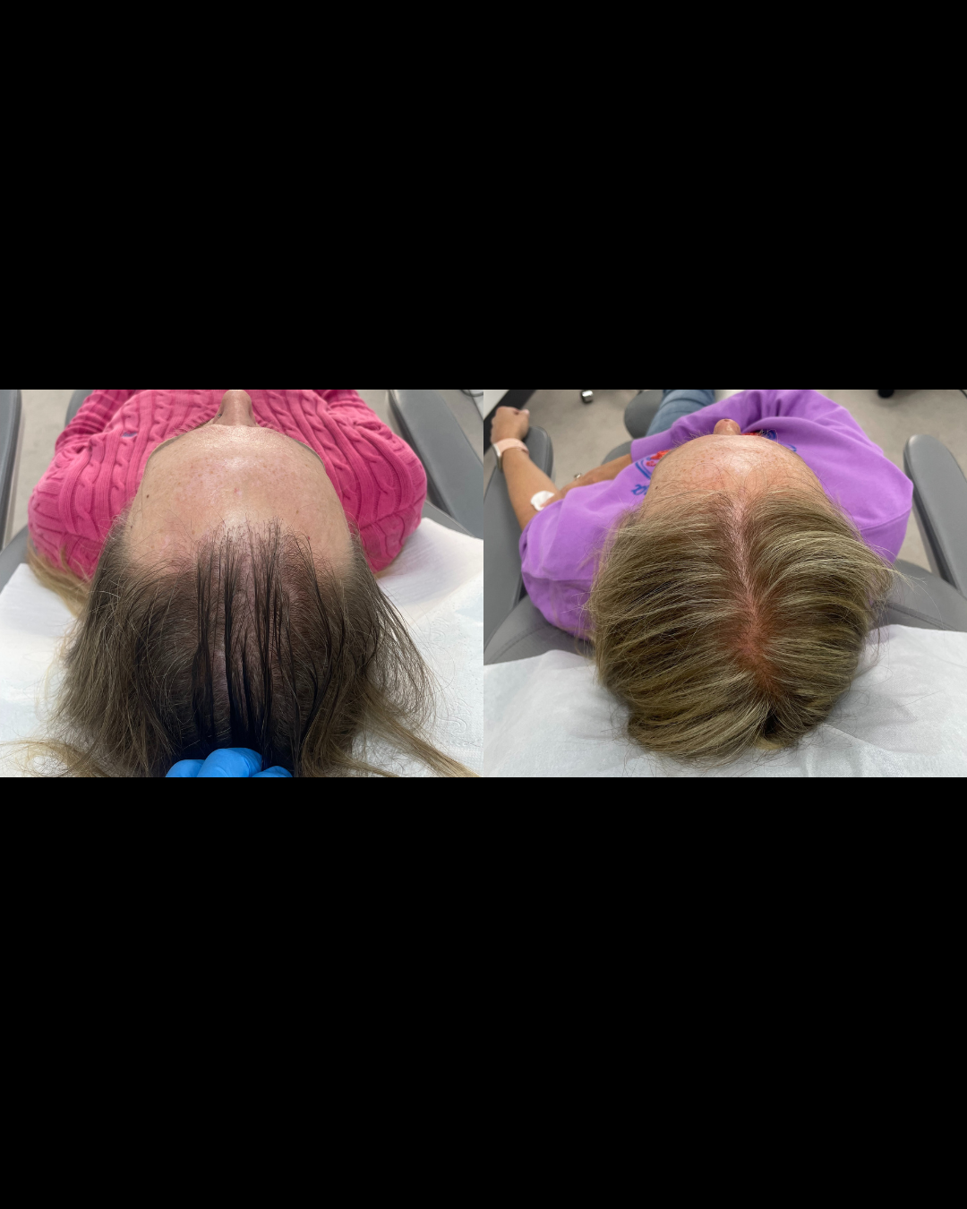 PRP Hair Restoration Before and After Result 2 – Oréa Aesthetics Clinic