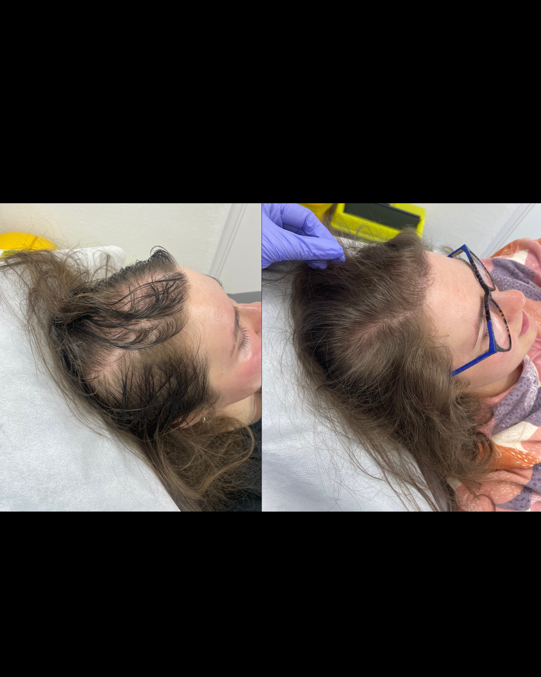 PRP Hair Restoration Before and After Result 3 – Oréa Aesthetics Clinic