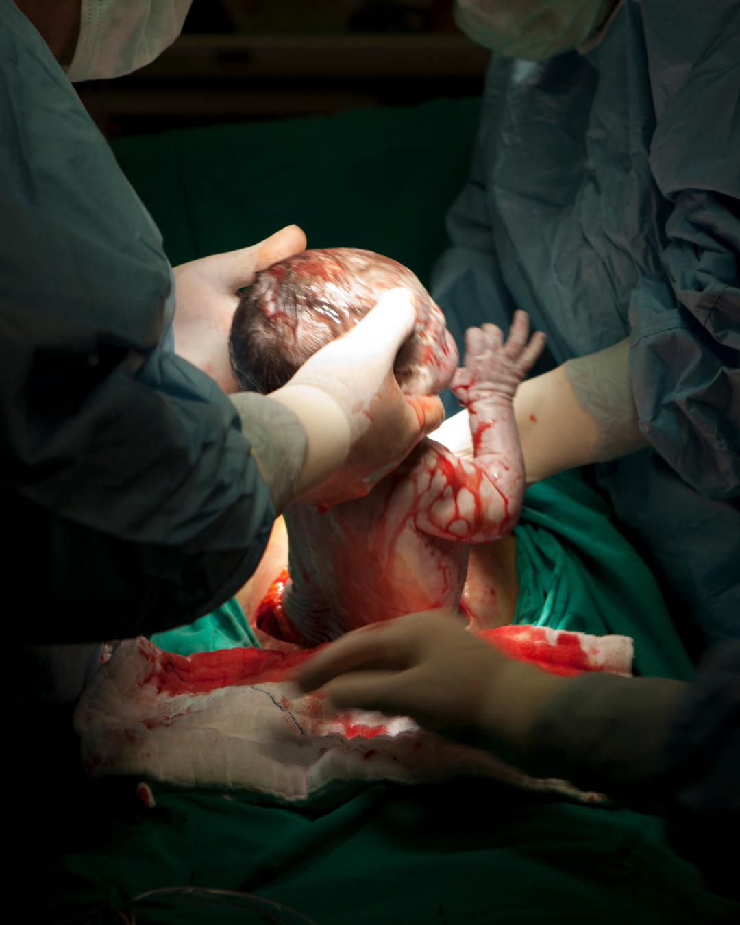 Un bébé à la naissance lors d'une césarienne