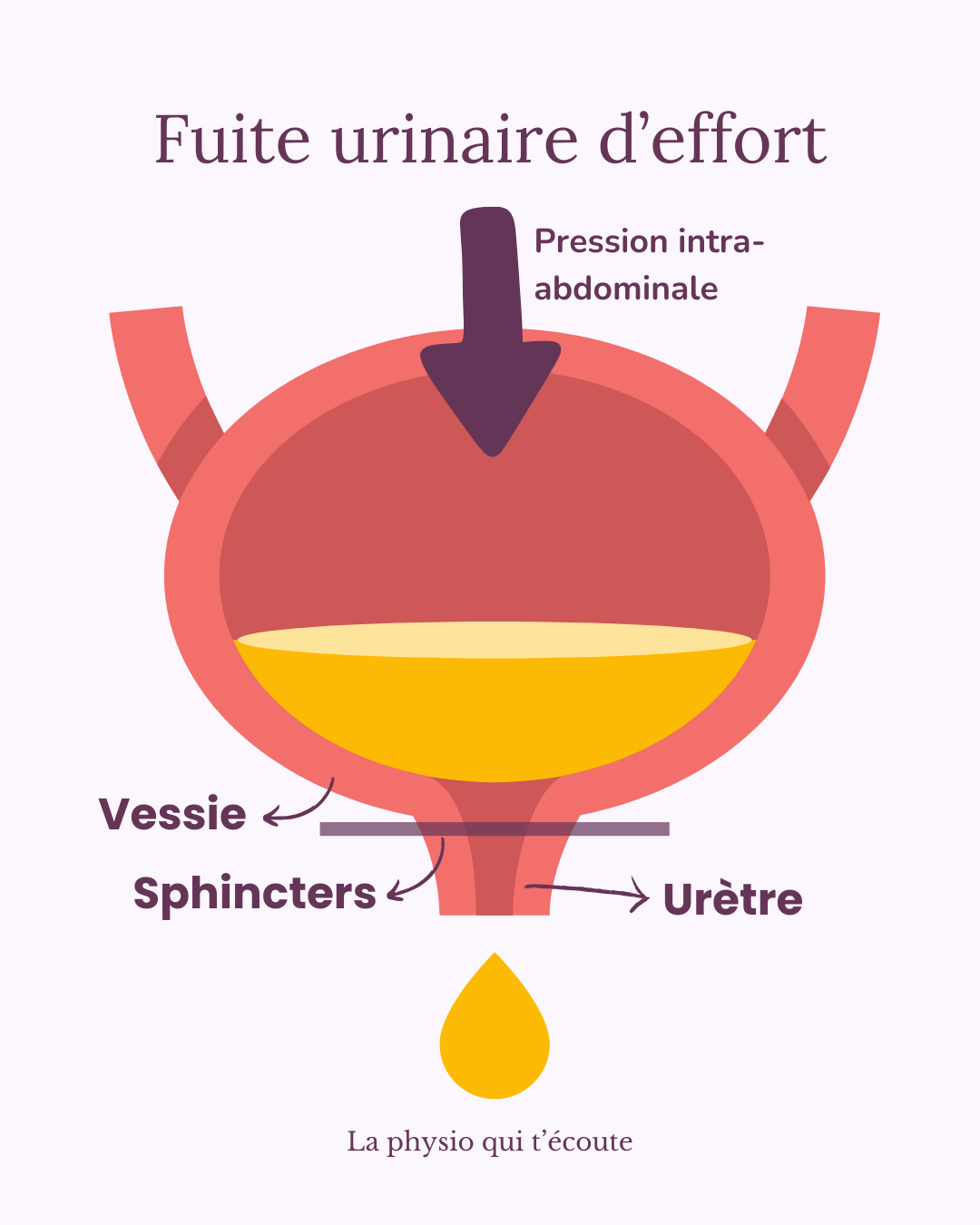 Ce qui se passe au niveau de la vessie lors d'une fuite urinaire d'effort Ce qui se passe au niveau de la vessie lors d'une fuite urinaire d'effort