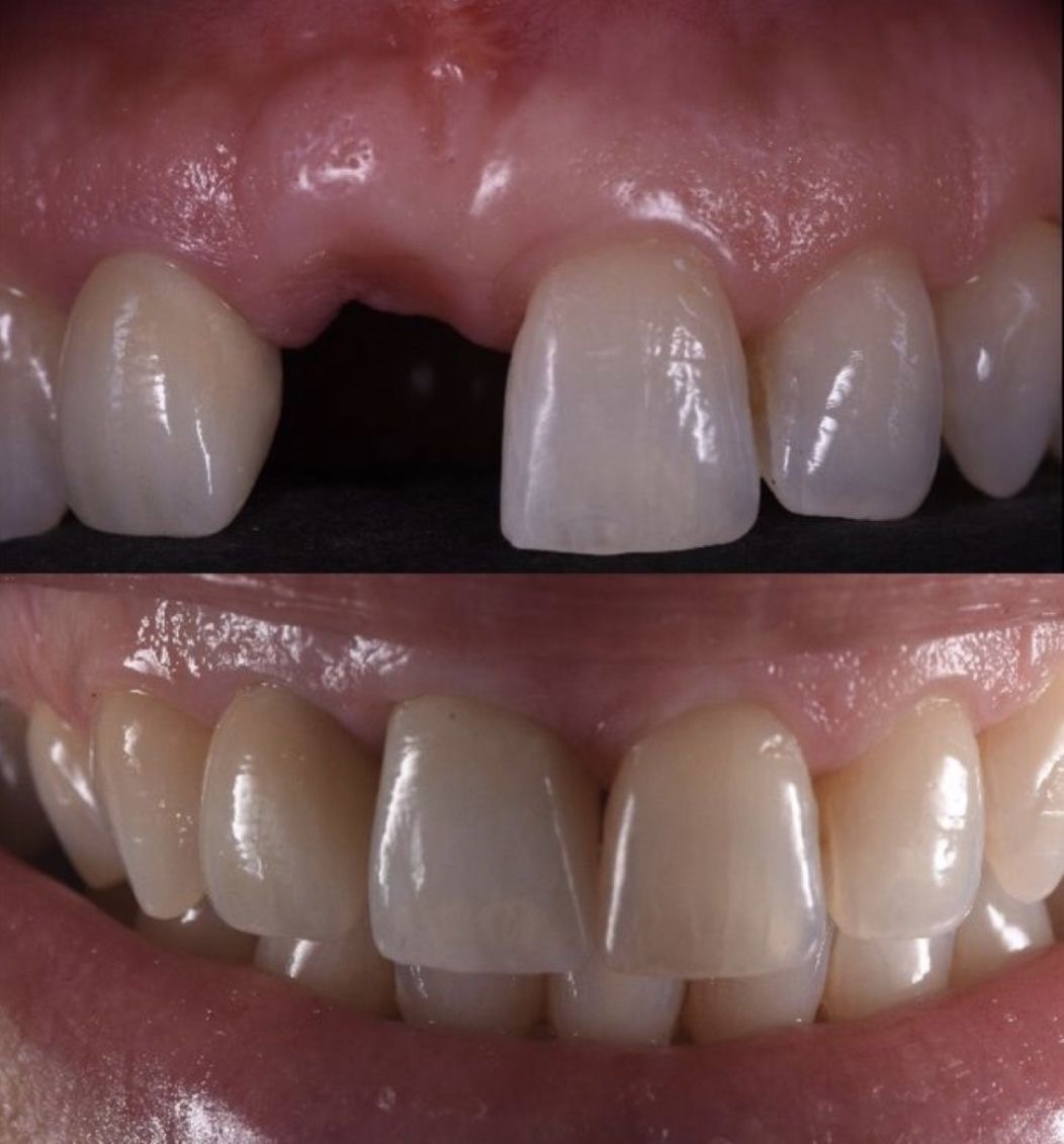 toxina botulinica santiago