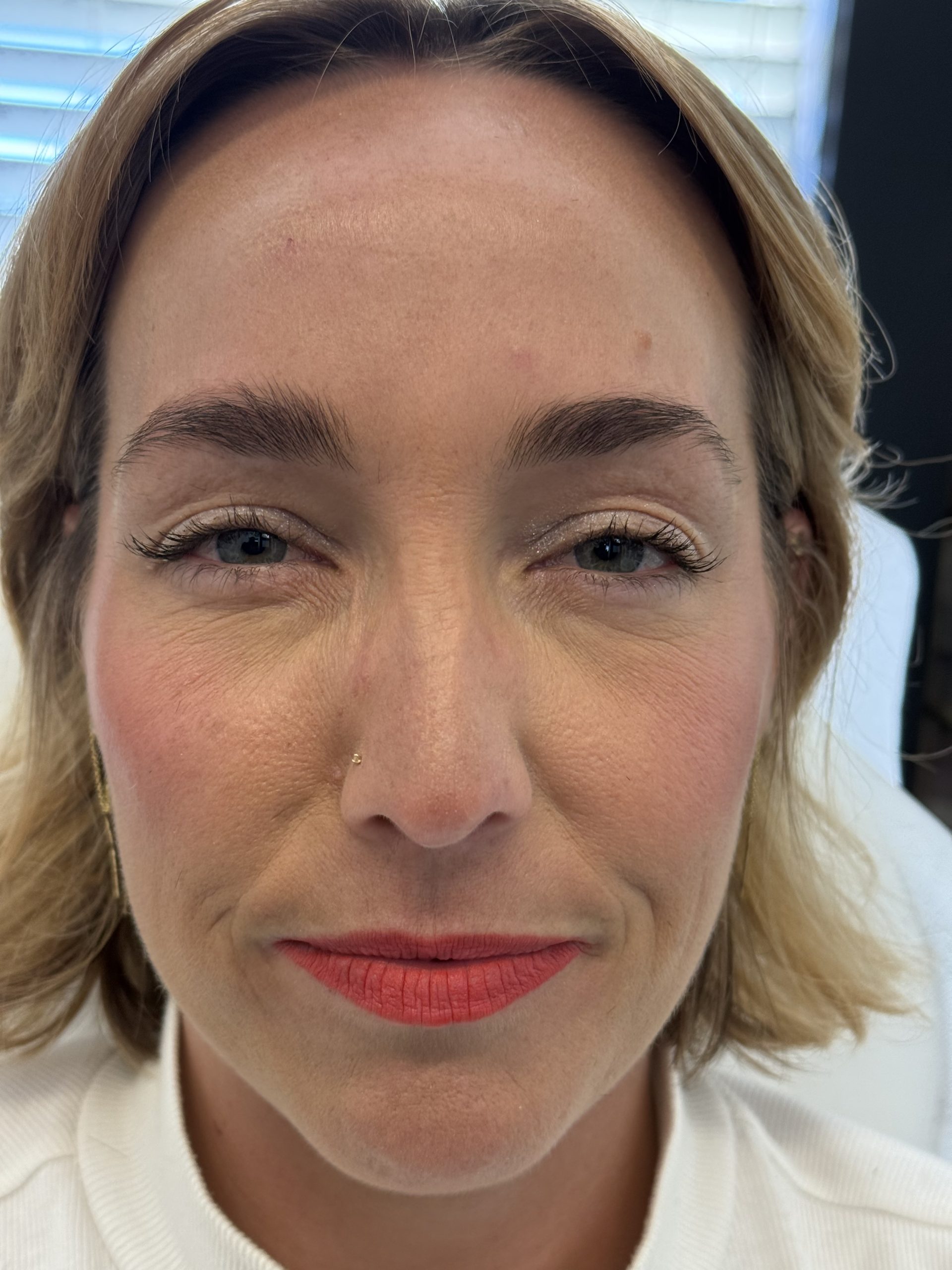 Forehead Lines After Botox