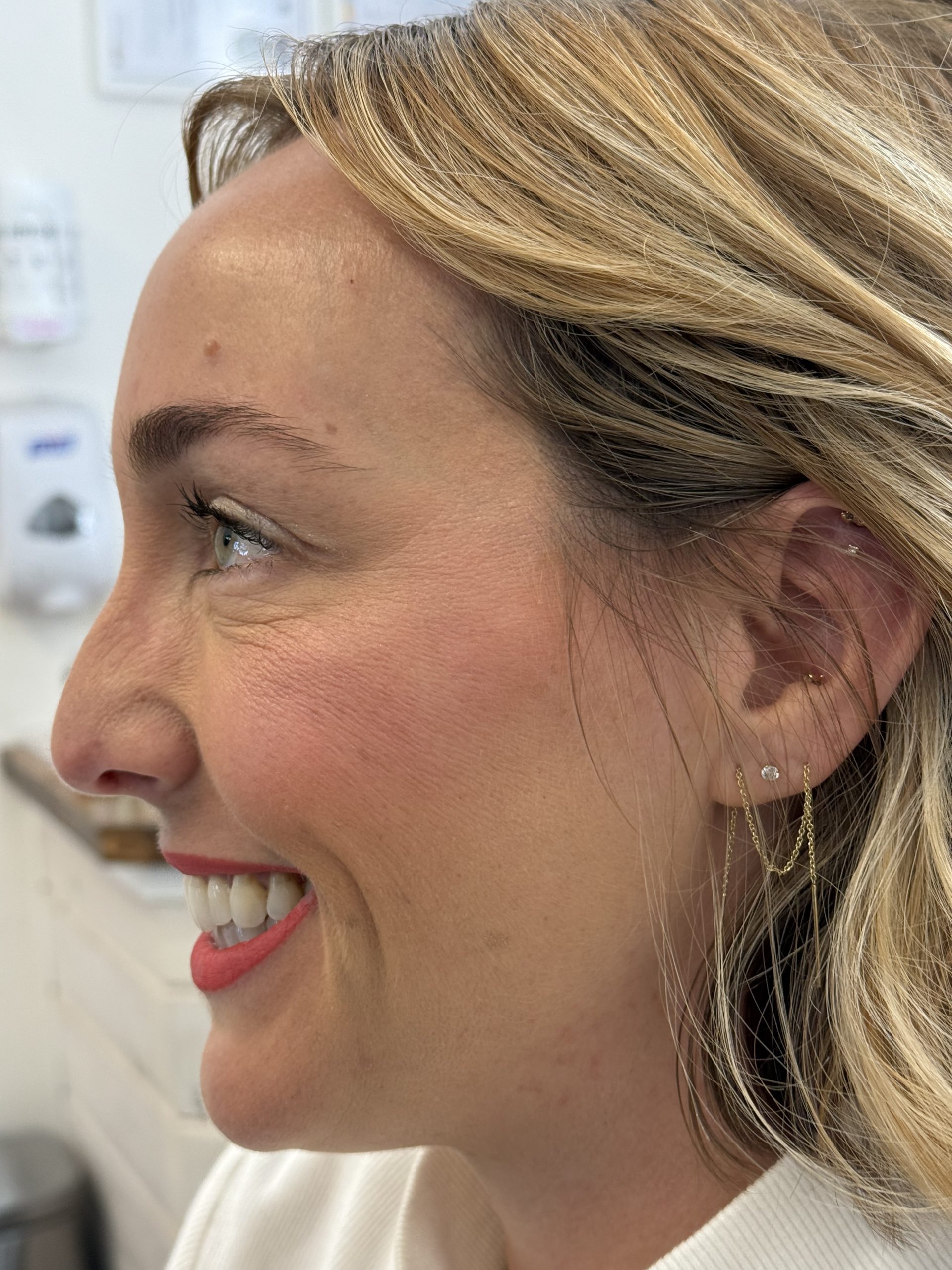 Crow's Feet After Botox