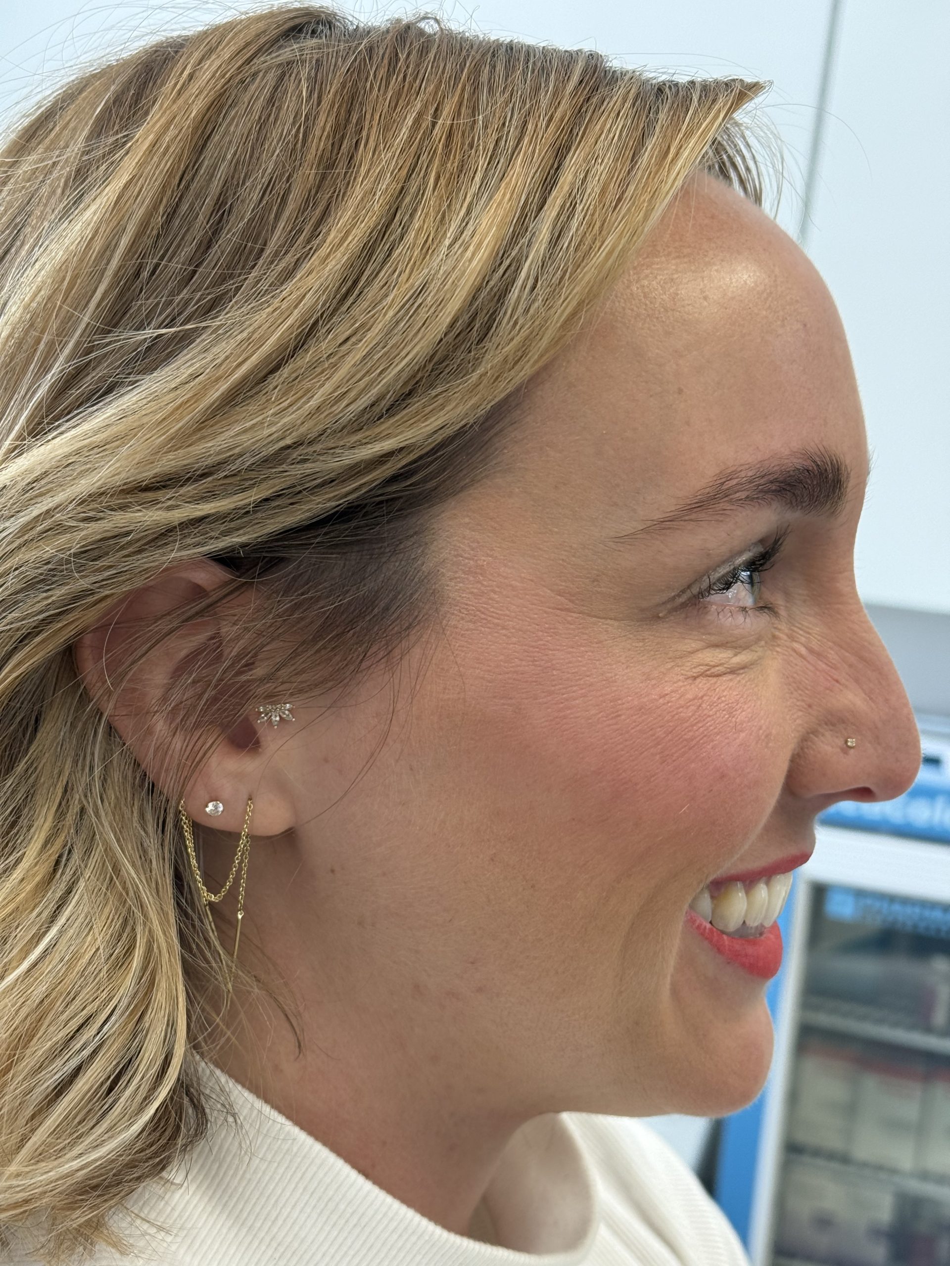 Crow's Feet After Botox