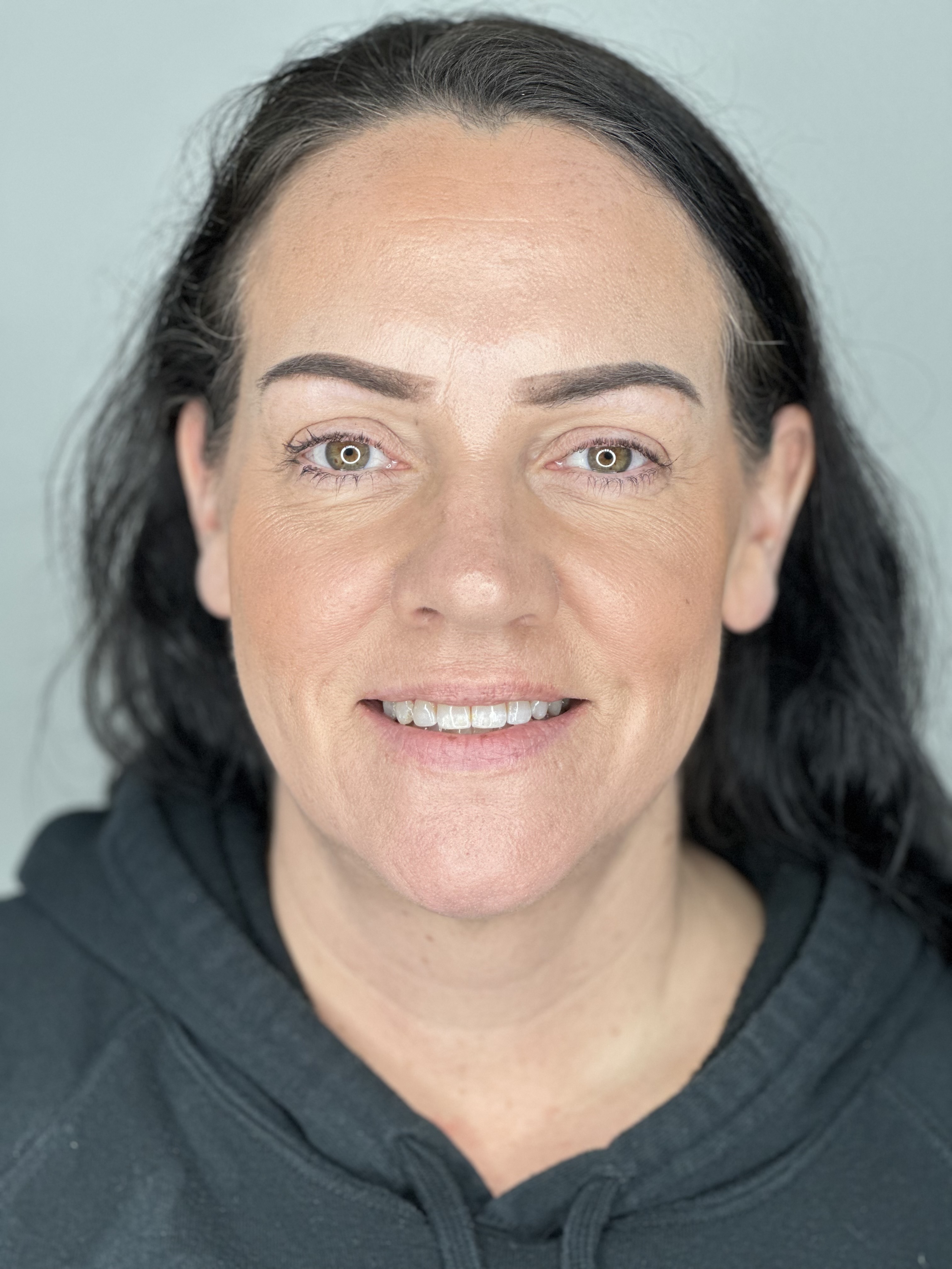 Patient before All-on-4 treatment