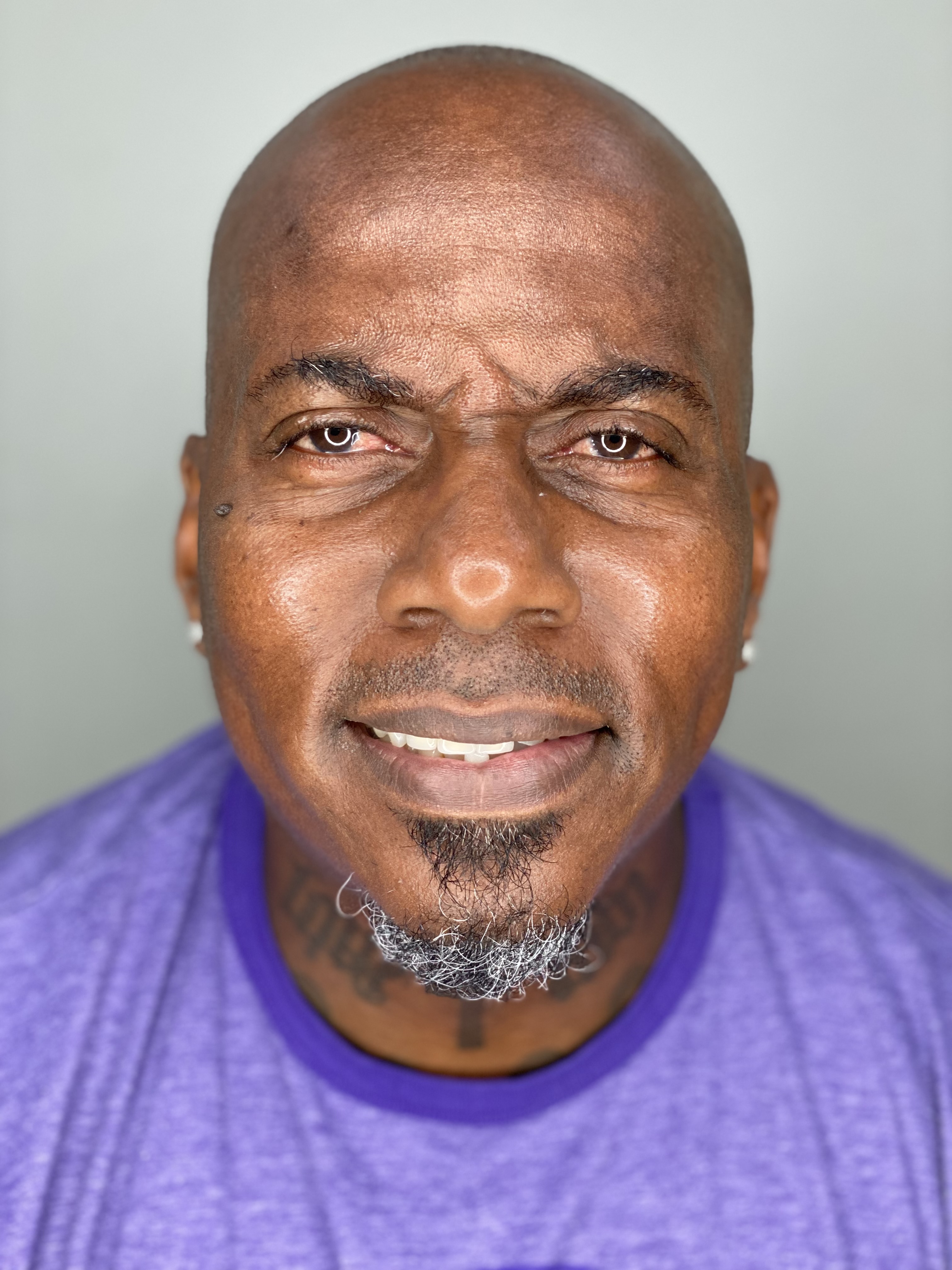 Patient before All-on-4 treatment