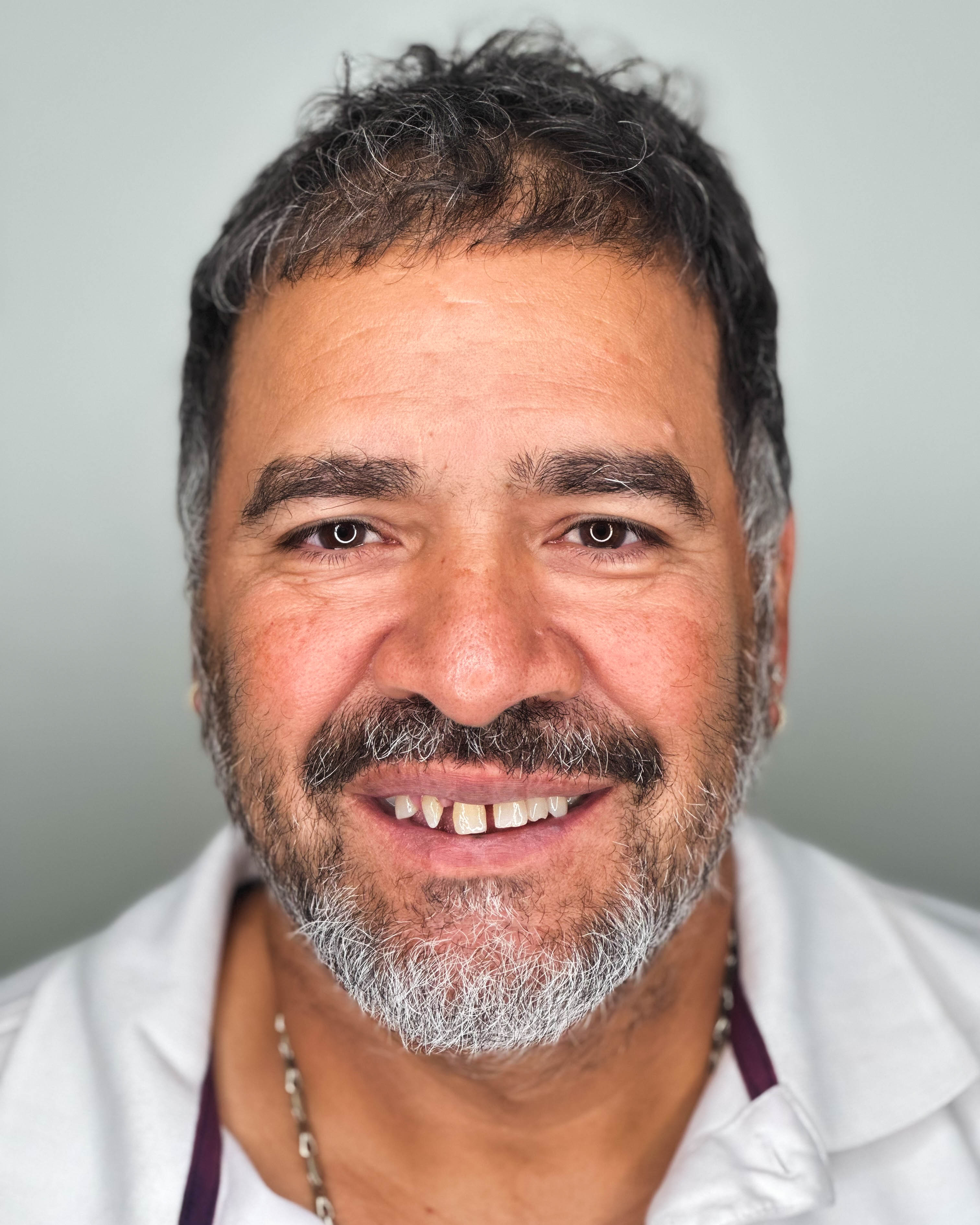 Patient before All-on-4 treatment