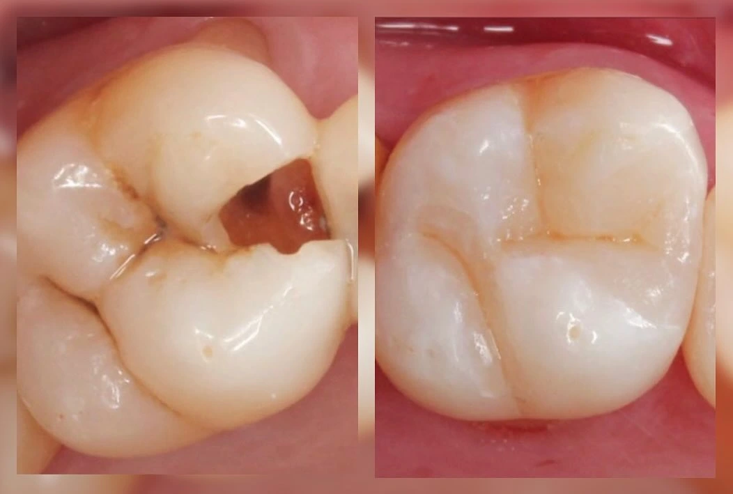 Before and after dental care result