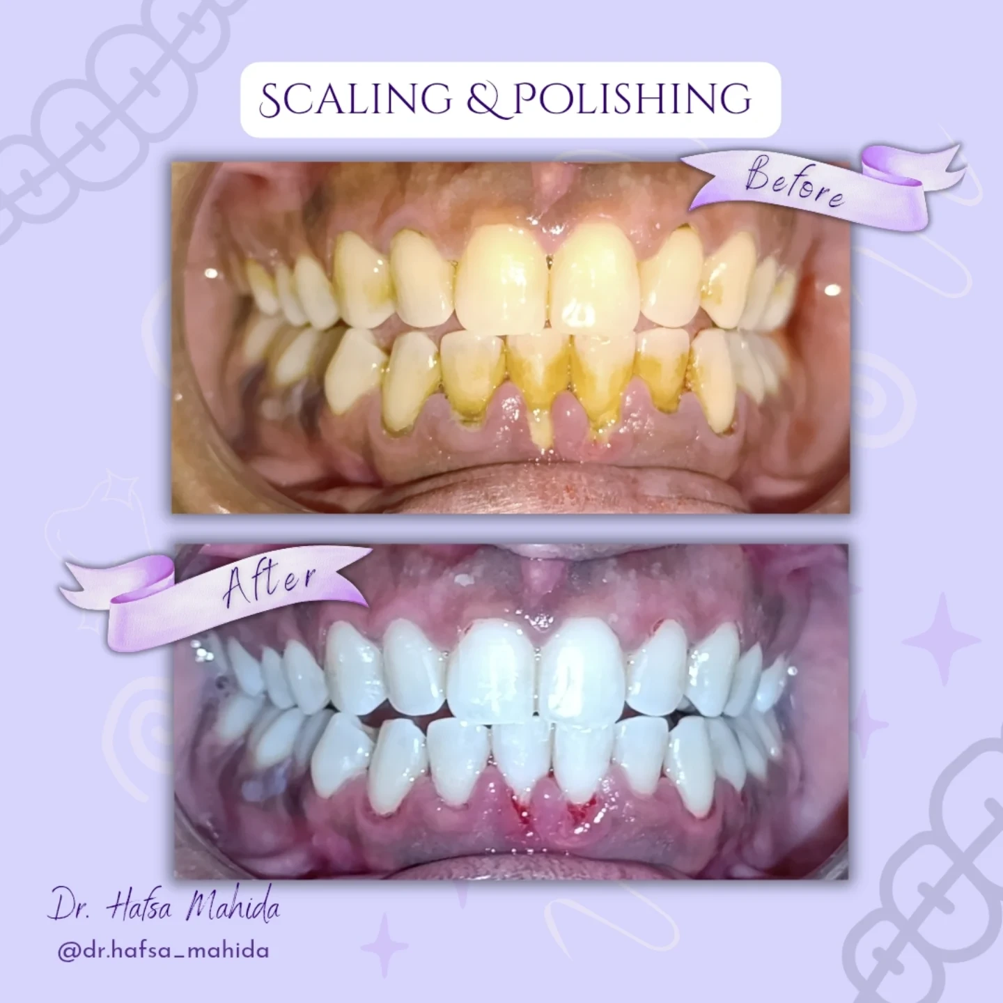 Dental before and after result