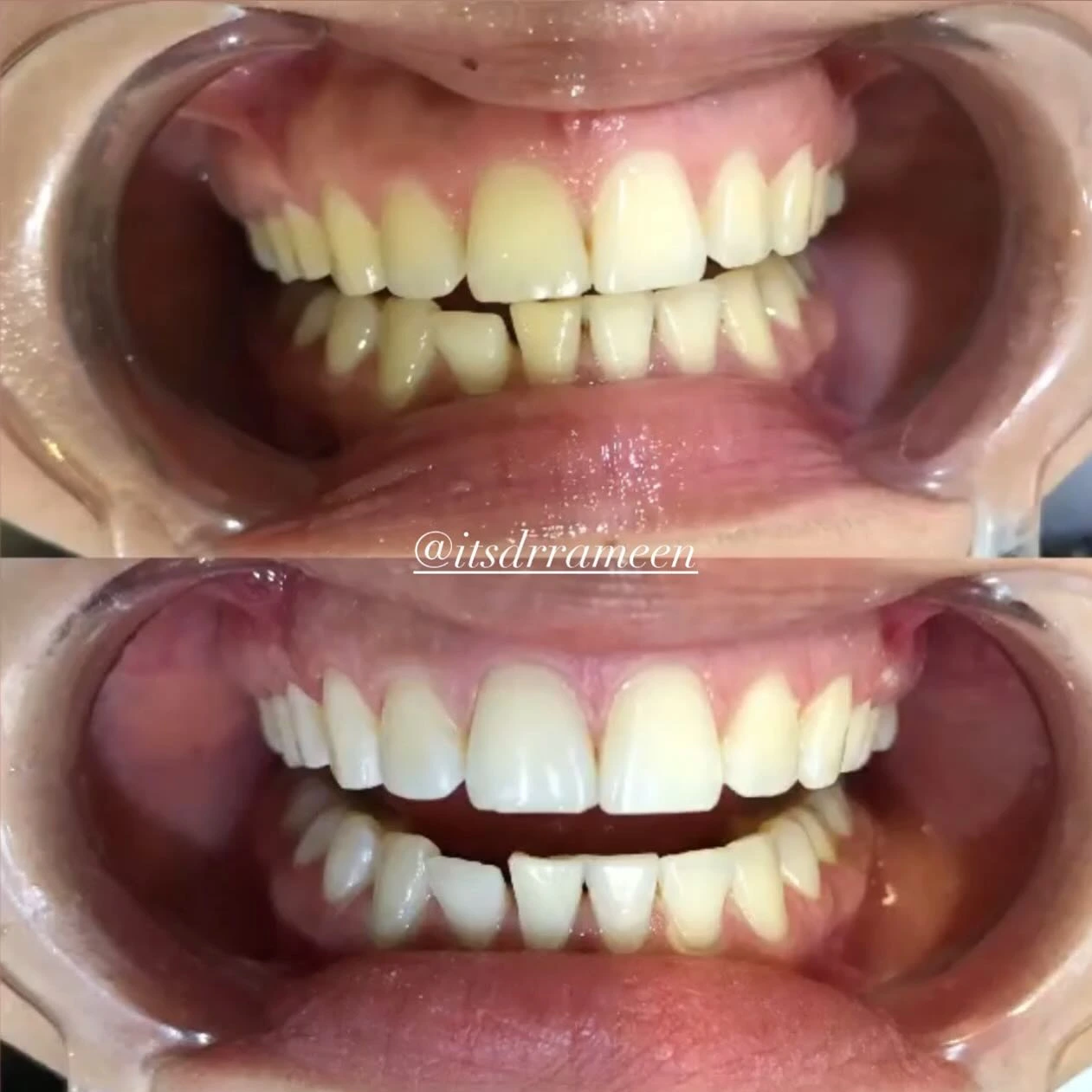 Dental smile before and after result