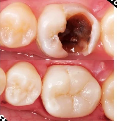 Dental before and after treatment result
