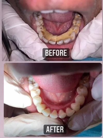 Before and after dental treatment result in DHA Karachi