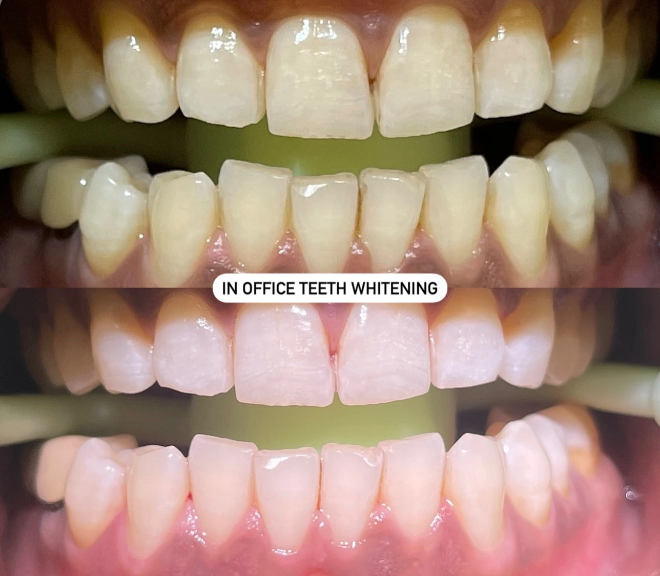 Dental treatment result before and after