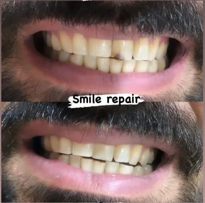 Dental treatment before and after result