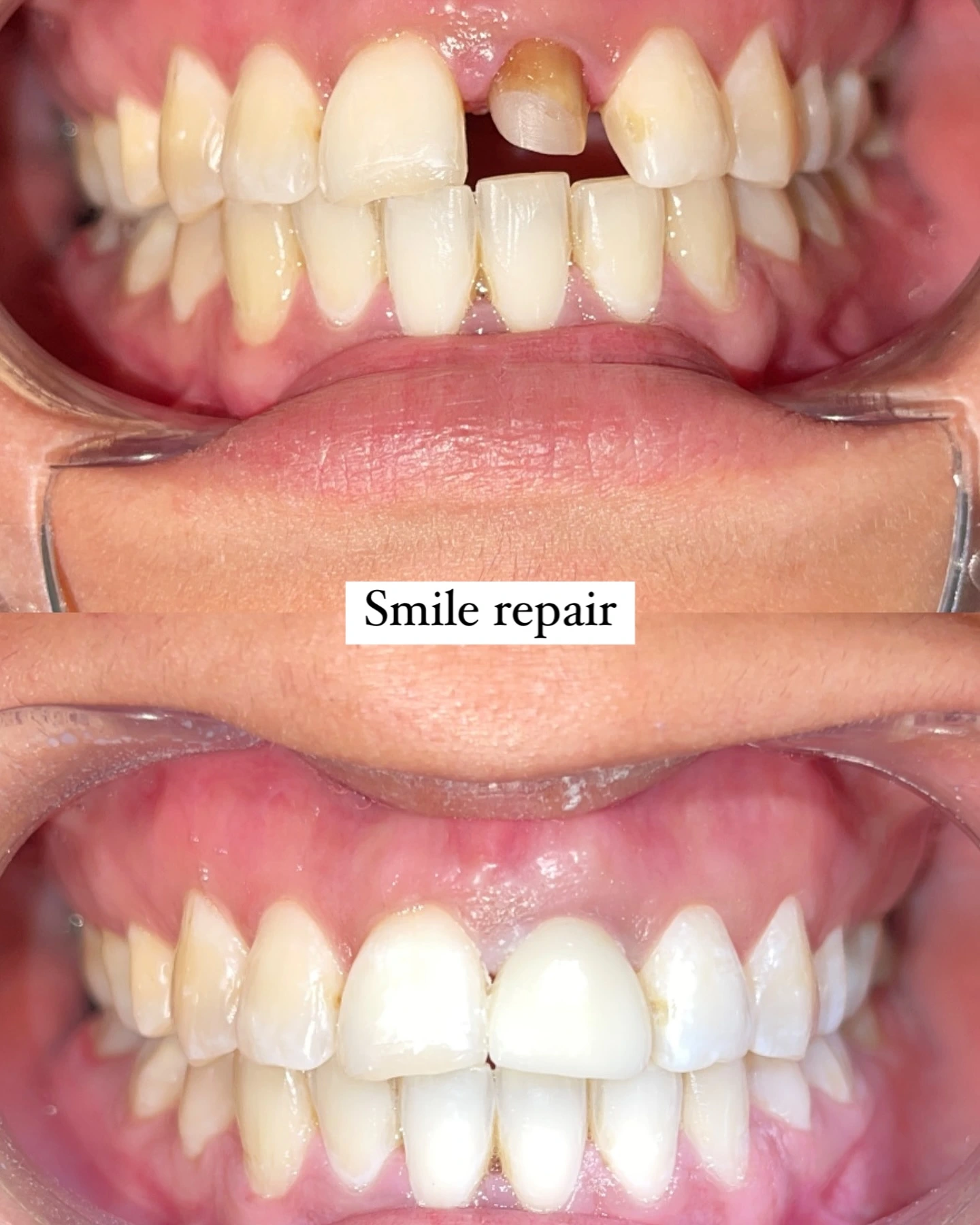Dental smile treatment result
